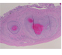 Isolated Right Testicular PAN (Polyarthritis Nodosa) Presenting As Right Testicular Pain