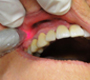 Low Level Laser (LLL) in dentistry