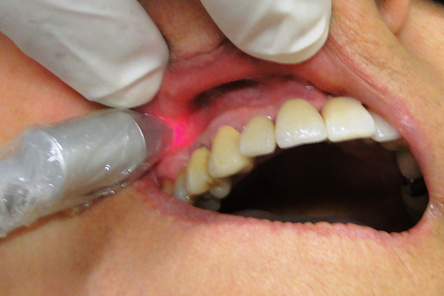Low Level Laser (LLL) in dentistry | International Journal of Clinical &  Medical Images