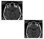 Undiagnosed Stage 4 Lupus Nephritis presenting as Right eye blindness from Superior Ophthalmic Vein Thrombosis