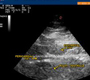 Obesity and cardiovascular risk: The role of epicardial fat measured by echocardiography