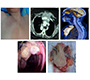 Metachronous Synchronous Sternal and Colonic Metastasis with Asymptomatic Colo-Colic Fistula from Carcinoma Ovary