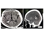 Choroidal Plexus Papiloma (CPP)