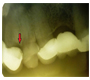 Diagnosing a Case of Cracked-Tooth Syndrome