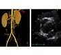 Type B Aortic Dissection and Bicuspid Aortic Valve