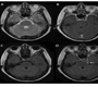 Contrast FLAIR Imaging may be Best Detectable for Leptomeningitis