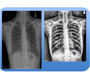 Pulmonary edema detection in chest x-ray using machine learning