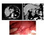 Gastric Cyst Suspected of Relapse of Mucinous Cystic Tumor of the Pancreas