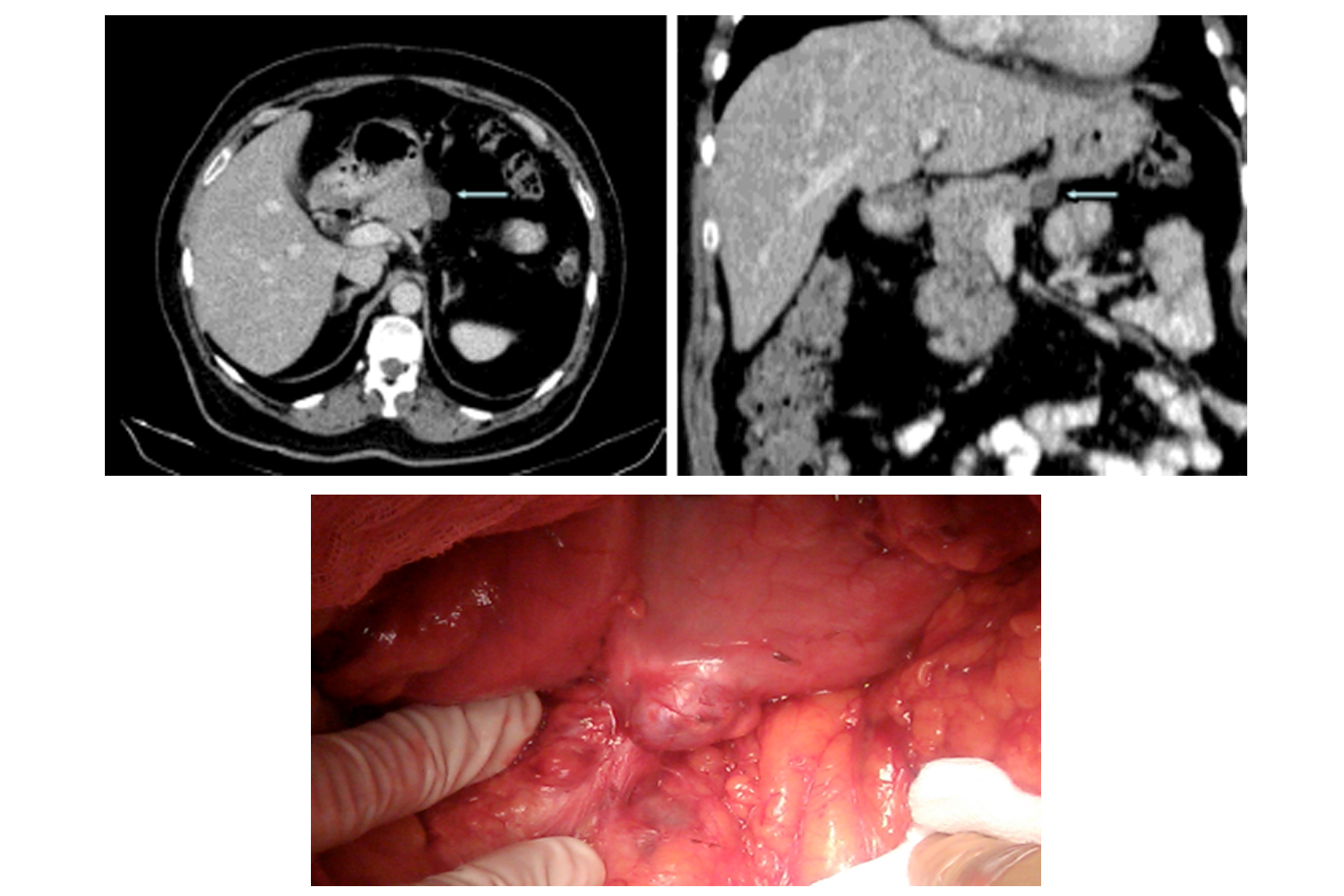 Gastric Cyst Suspected of Relapse of Mucinous Cystic Tumor of the Pancreas