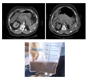 Am I Aspirating Ascites or Feces? An Interesting Case of Pancreatitis Caused By Mild Hypertriglyceridemia