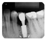 Auxiliary Method for the Diagnosis of the Implant Periapical Lesion