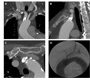 Blood Pressure Difference of more than 100 mmHg between Arms caused by Stenosis of the Brachiocephalic Trunk