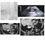 Hepatic Abscesses, Portal Cavernoma and Forgotten Biliary Stent: Is there a Relationship?