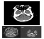 Rare Association of Central Pontine Myelinolysis with Diabetic Hyperglycemia: CPM Associated with Hyperglycemia