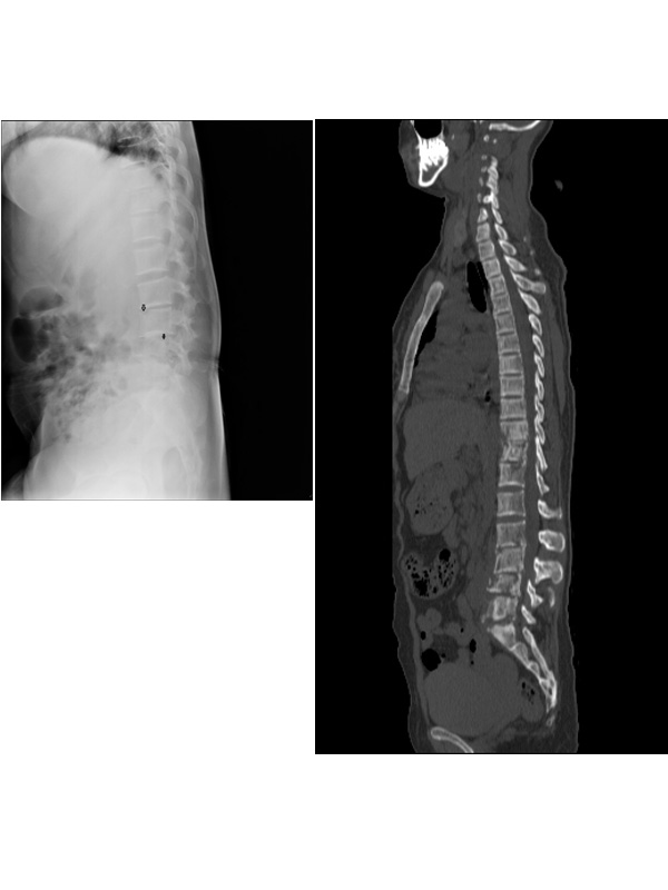 Vertebral Signal Abnormalities in a Sickle Cell Patient