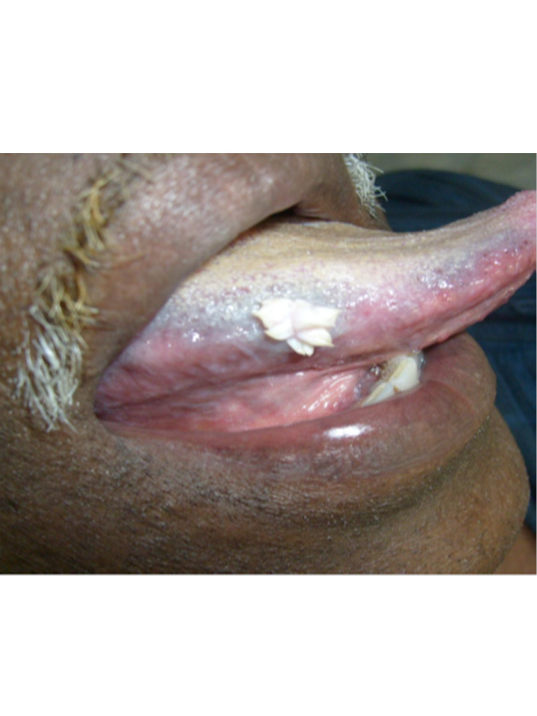 papillomas tongue