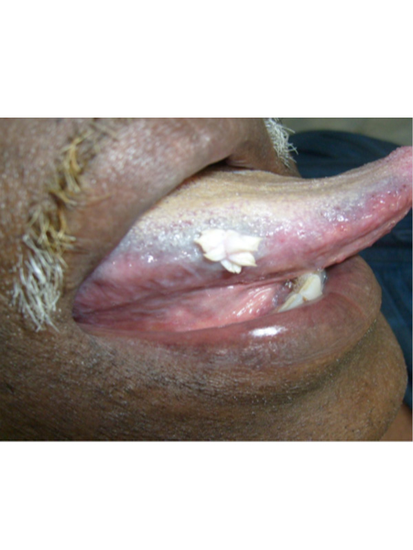 squamous papilloma on the tongue