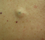 Epidermoid Cyst