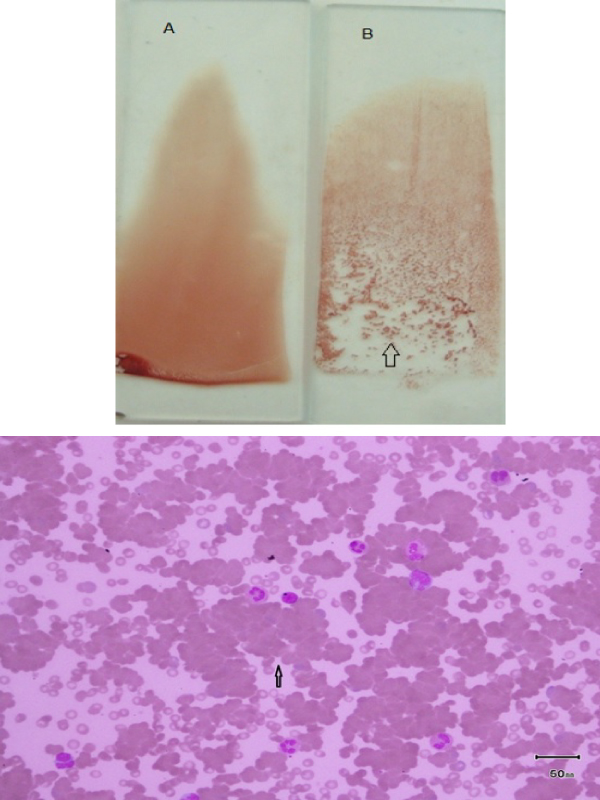 A Case of Cold Agglutinin Disease Associated with Mycoplasma Pneumonia