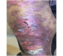 A Rare Report of Verrucouse Carcinoma of Right Leg - A Clinical Image