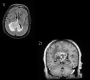 Butterfly Glioma Involving Splenium of Corpus Callosum