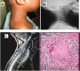 A Rare Cause of Retropharyngeal Abscess: Cervical Pottï¿½s disease