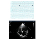 A Case of LV False Tendon with Ventricular Tachycardia