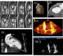 Apical Left Ventricular Akinesis in Middle-Aged Endurance Athlete: A Clinical Dilemma