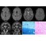 Atrophy and Demyelination of Putamen: A Case of High Concordance between Imaging and Histology