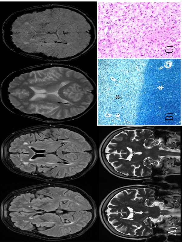 Atrophy and Demyelination of Putamen: A Case of High Concordance between Imaging and Histology