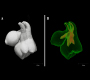 Fused teeth; three-dimensional representation of the external and internal structure