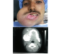 Giant Amelobelastoma with Mandibular Invasion