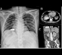 A Retrocardiac Opacity in a Cirrhotic Patient - Esophageal Varices