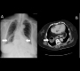 A Retrocardiac Gas-filled Mass ï¿½ Hiatal Hernia