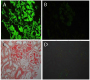 A Case of AL Amyloidosis