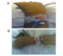 A Rare Technical Error about Angiocath Placement in an Old Patient with Recent Cerebrovascular Accident