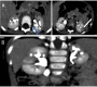 CT Signs of Intrarenal Reflux