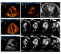 Cardiovascular Imaging of Prominent Crista Terminalis