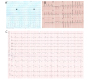 Spontaneous All Three Electrocardiographic Patterns in Same patient with Brugada Syndrome