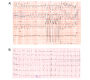 Uncommon Cause of Wide QRS Complex Tachycardia, Mahaim Tachycardia Revisited