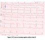 Appropriate Localisation of Epicardial Accessory Pathway of WPW Sydrome-Initial Step to Success