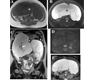 Bilateral Theca-lutein Cysts in One Pregnant Woman at MRI