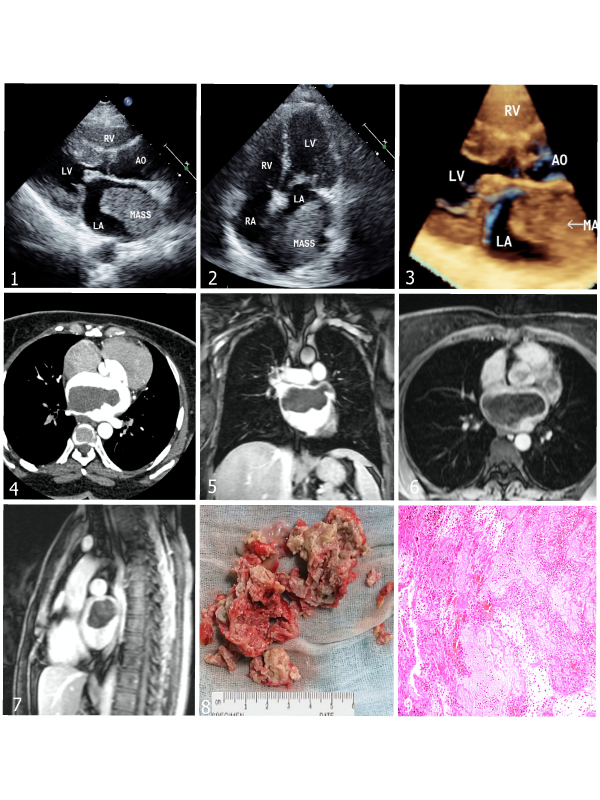 Giant Left Atrium with Large Thrombus - Comprehensive Evaluation and Management