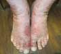 Impetiginized Psoriasis