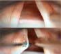 Unusual Case of a Mucosal Bridge of the Vocal Cord