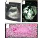 Primary Cold Abscess of Rectus Abdominis Muscle