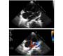 Rare Case of Triatrial Heart with Unroofed Coronary Sinus