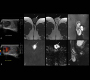 Classic Testicular Seminoma on MR and Ultrasound