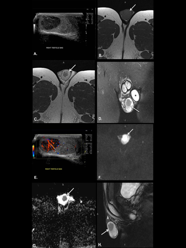 Classic Testicular Seminoma on MR and Ultrasound