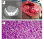 Intra-abdominal Testicular Seminoma